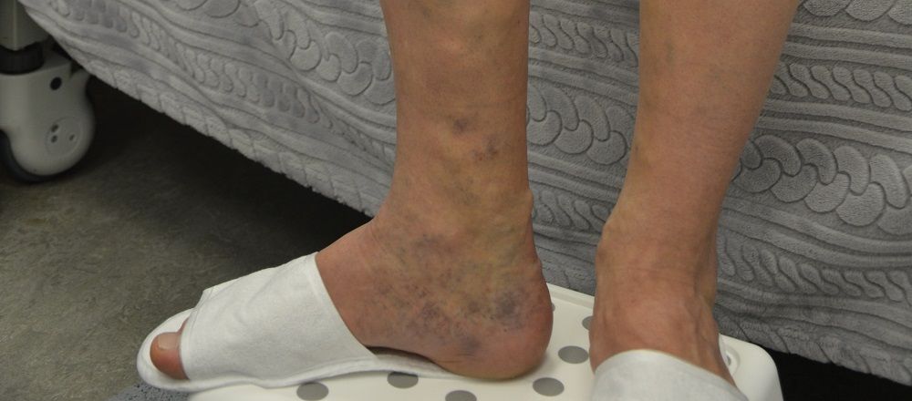 Отеки ног - причины, симптомы, лечение в медицинском центре Звезда