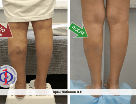 Причины и лечение выпирающих вен на ногах