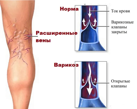 Лечение варикозного расширения вен на ногах